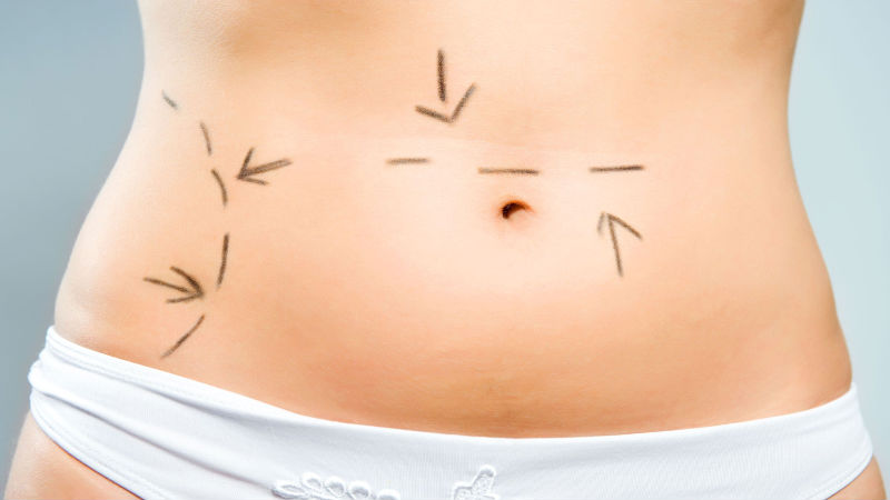 The Benefits of CoolSculpting in Chevy Chase MD