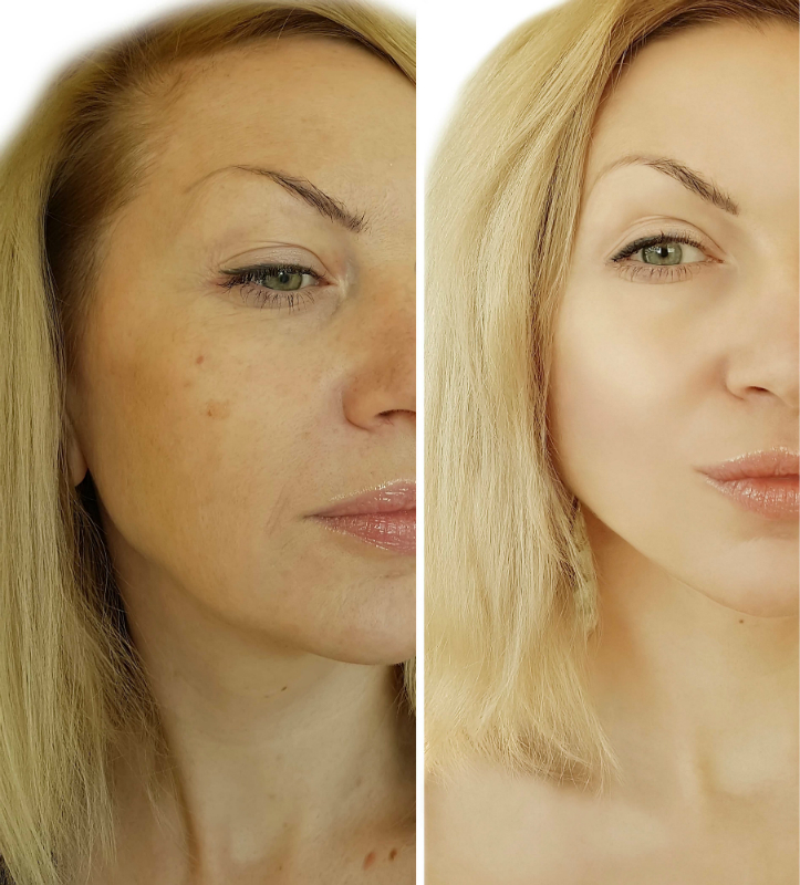 Get Gorgeous Skin & a Youthful Glow With a Chemical Peel in Charleston, SC